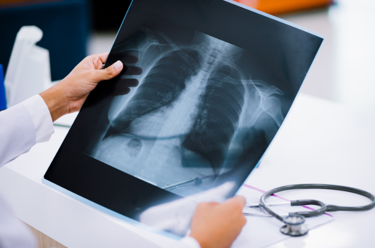 Chest-X-Ray.pn